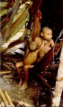 Mother and son with Malaria and malnutrition