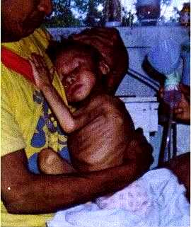 Kaiap&oacute; indian children with malnutrition and intense respiratory infection